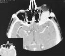 Fig. 3 ­ Aspect tomodensitométrique. Lésion   rétrooculaire gauche hyperdense