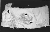Fig.   4 ­ Reconstruction tridimensionnelle surfacique