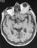 Fig. 5 ­ Séquence IRM pondérée en 	  T1