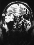 Fig. 7 ­ Coupes coronales. Séquence IRM 	  pondérée en T2
