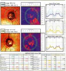 GDX - DR Glaucome.net