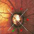 Analyse de Moorfields - DR Glaucome.net