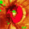 Analyse de progression, HRT - DR Glaucome.net
