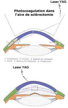 Réalisation du laser YAG pour remontée tensionnelle ( Institut du Glaucome - Fondation Hôpital Saint-Joseph - Paris )