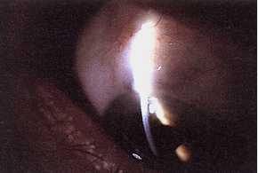 bulle de filtration: sclérectomie profonde ( Institut du Glaucome - Fondation Hôpital Saint-Joseph - Paris )